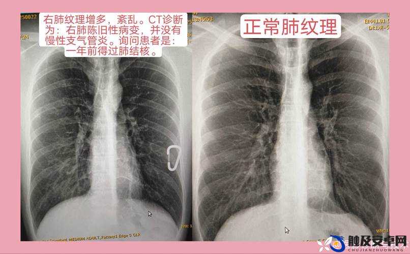 100 胸片曝光率 2024 对医疗诊断的重要性及影响分析